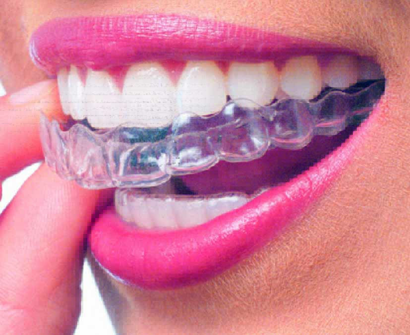 what is invisalign
